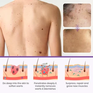 ✅ Official Store: Medazy™ Clarivine Dissolver Mole & Dark Spot Removal Bio-Gel