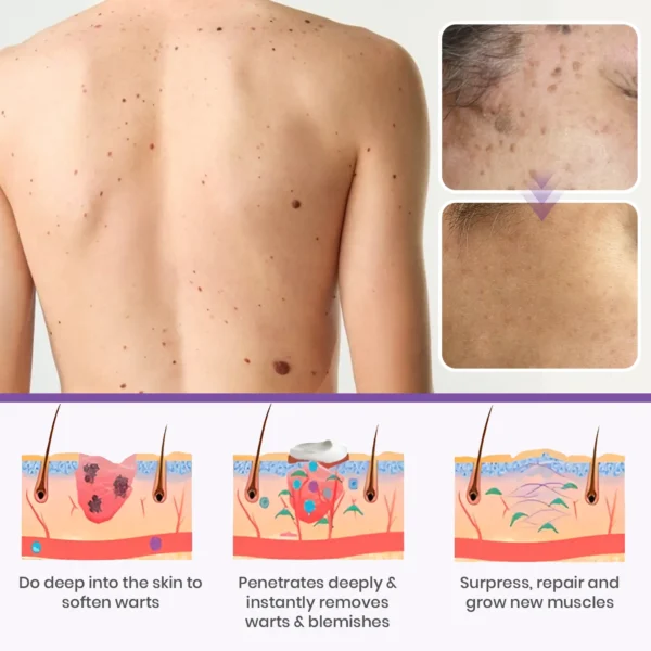 ✅ Official Store: Medazy™ Clarivine Dissolver Mole & Dark Spot Removal Bio-Gel