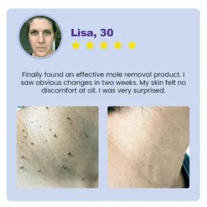 ✅ Official Store: Medazy™ Clarivine Dissolver Mole & Dark Spot Removal Bio-Gel