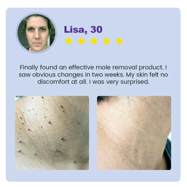✅ Official Store: Medazy™ Clarivine Dissolver Mole & Dark Spot Removal Bio-Gel