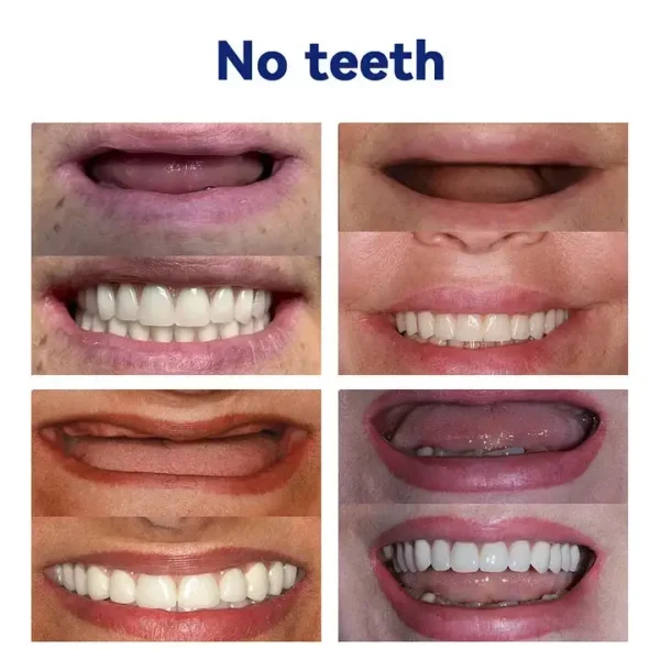AQA™-New Generation Flexible Full Denture Solution