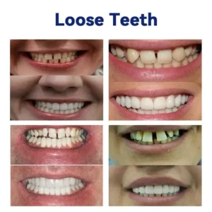 AQA™-New Generation Flexible Full Denture Solution