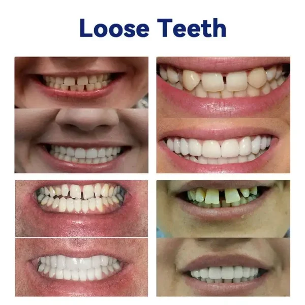 AQA™-New Generation Flexible Full Denture Solution