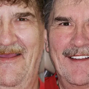 INSIDEEFY™ --🦷Advanced Customized Full Denture Set🦷 {Developed by Harvard University}