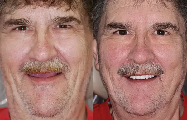 INSIDEEFY™ --🦷Advanced Customized Full Denture Set🦷 {Developed by Harvard University}