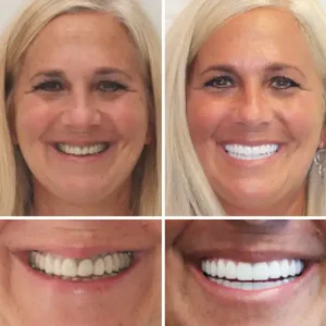 INSIDEEFY™ --🦷Advanced Customized Full Denture Set🦷 {Developed by Harvard University}