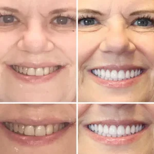 INSIDEEFY™ --🦷Advanced Customized Full Denture Set🦷 {Developed by Harvard University}