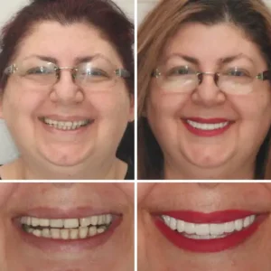 INSIDEEFY™ --🦷Advanced Customized Full Denture Set🦷 {Developed by Harvard University}