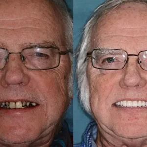 INSIDEEFY™ --🦷Advanced Customized Full Denture Set🦷 {Developed by Harvard University}
