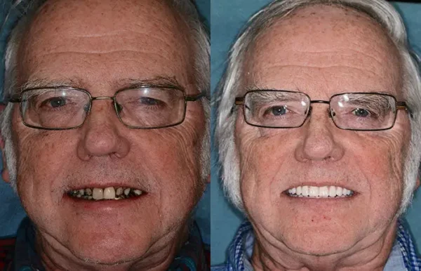 INSIDEEFY™ --🦷Advanced Customized Full Denture Set🦷 {Developed by Harvard University}