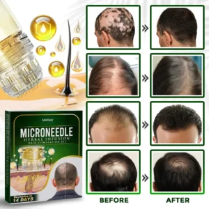 Medazy® Microneedle Herbal Infusion Hair Stimulation Set