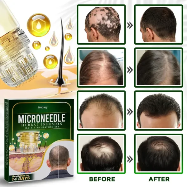 Medazy® Microneedle Herbal Infusion Hair Stimulation Set